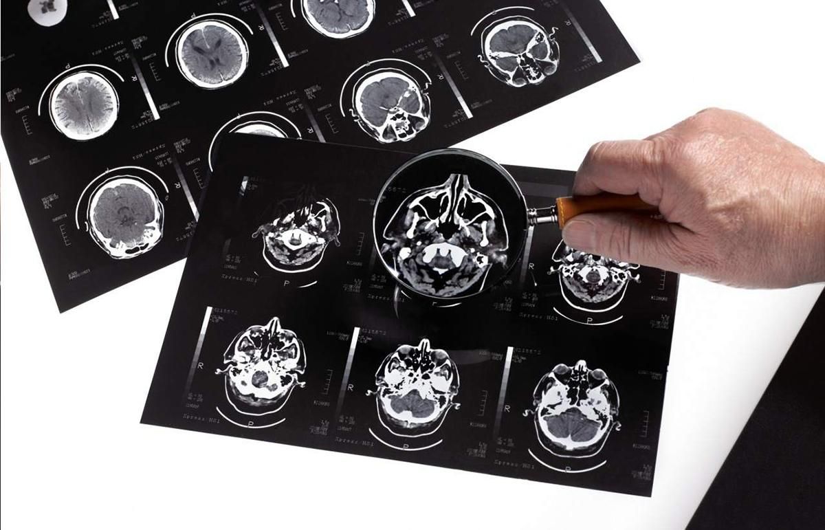 Можно ли самостоятельно лечить головную боль: невролог ответила на популярные вопросы