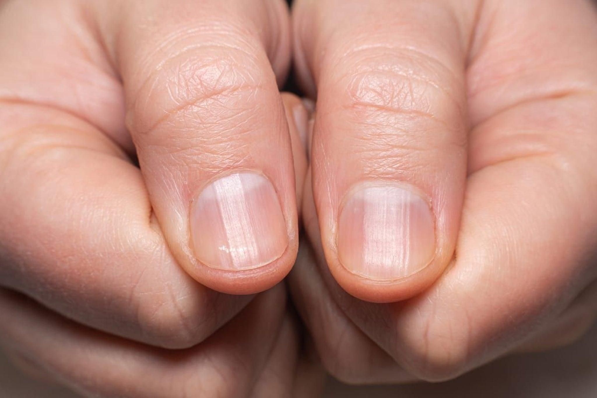 Коронавірусні нігті: як розпізнати новий симптом постковіду