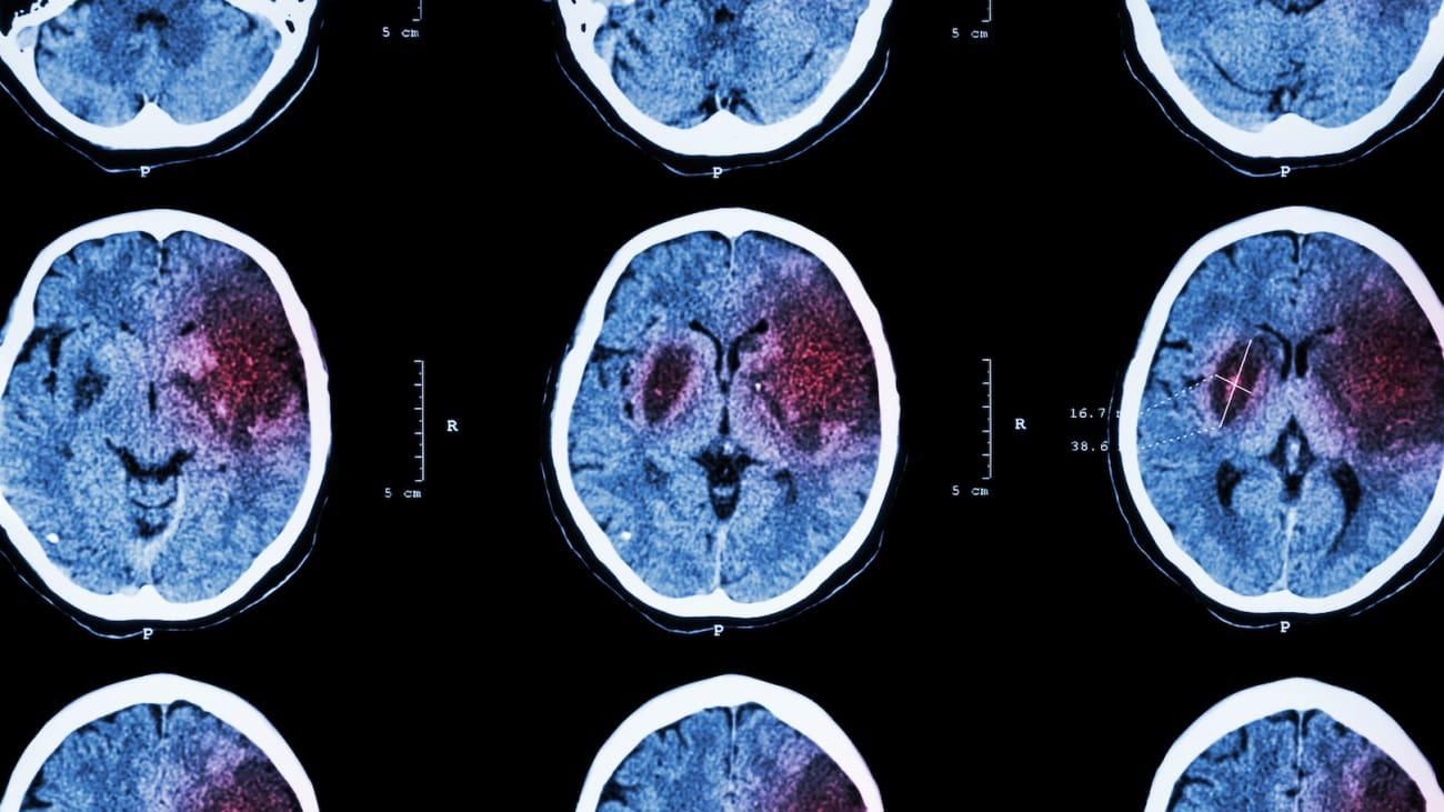 Коронавірус змінює обсяг сірої речовини в мозку: дослідження