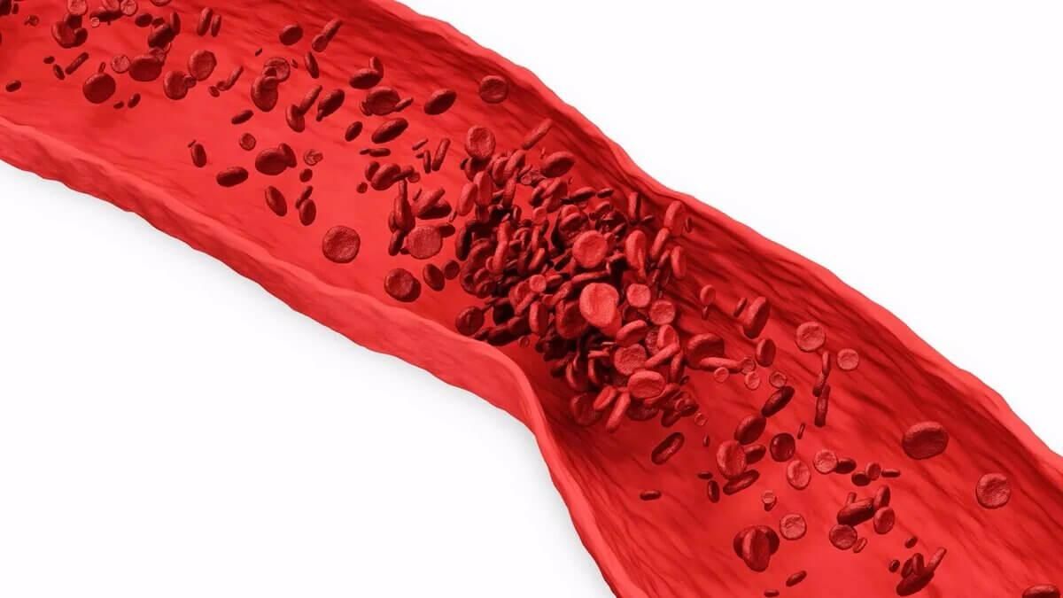 Закупорка судин: вчені зрозуміли фізику утворення згустків крові