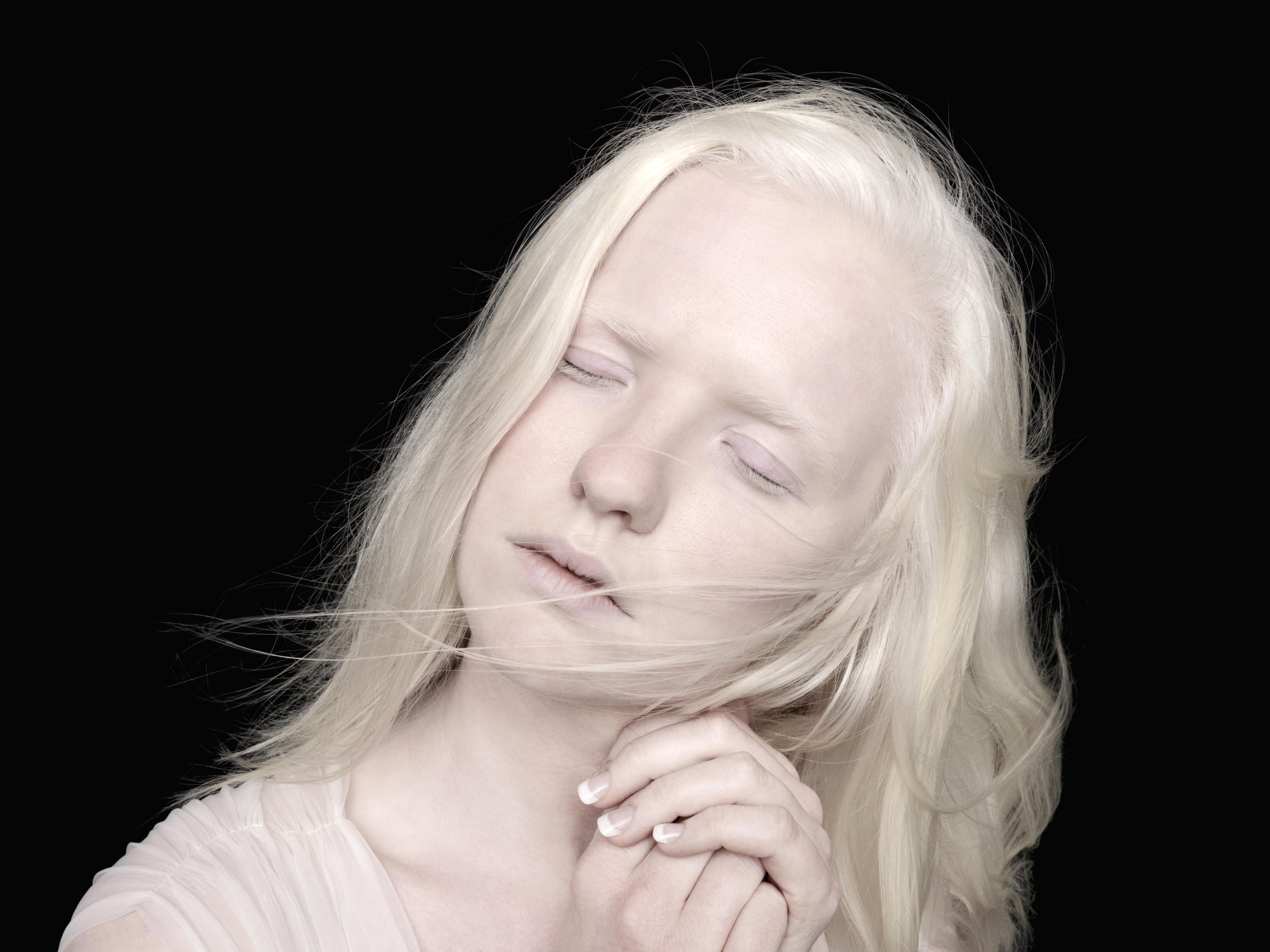 Что надо знать об альбинизме