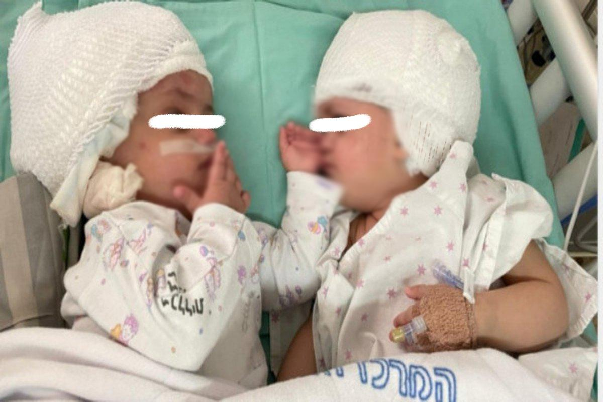 В Ізраїлі провели унікальну операцію: розділили сіамських близнюків - новини Ізраїлю - Новини Здоров’я