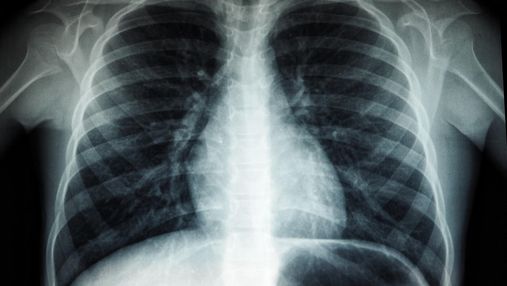 Чому в некурців виникає рак легенів: нові дані 
