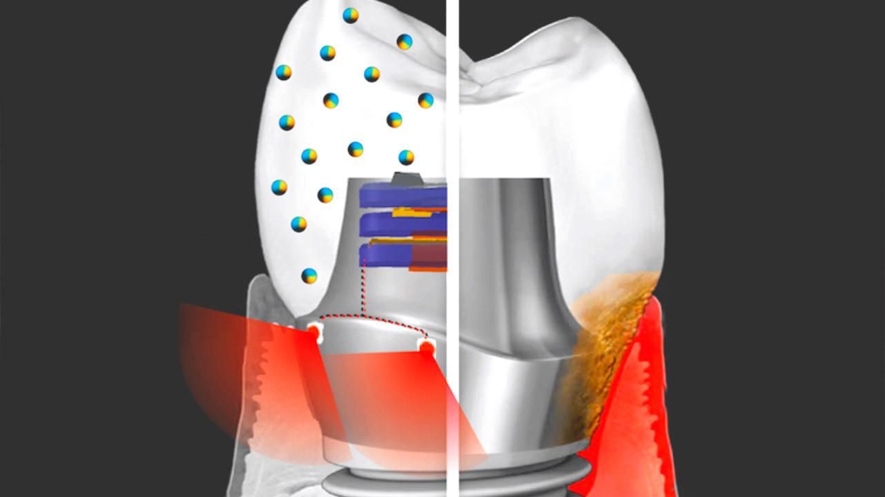 Создали зубной имплант, который поможет сохранить здоровье ротовой полости