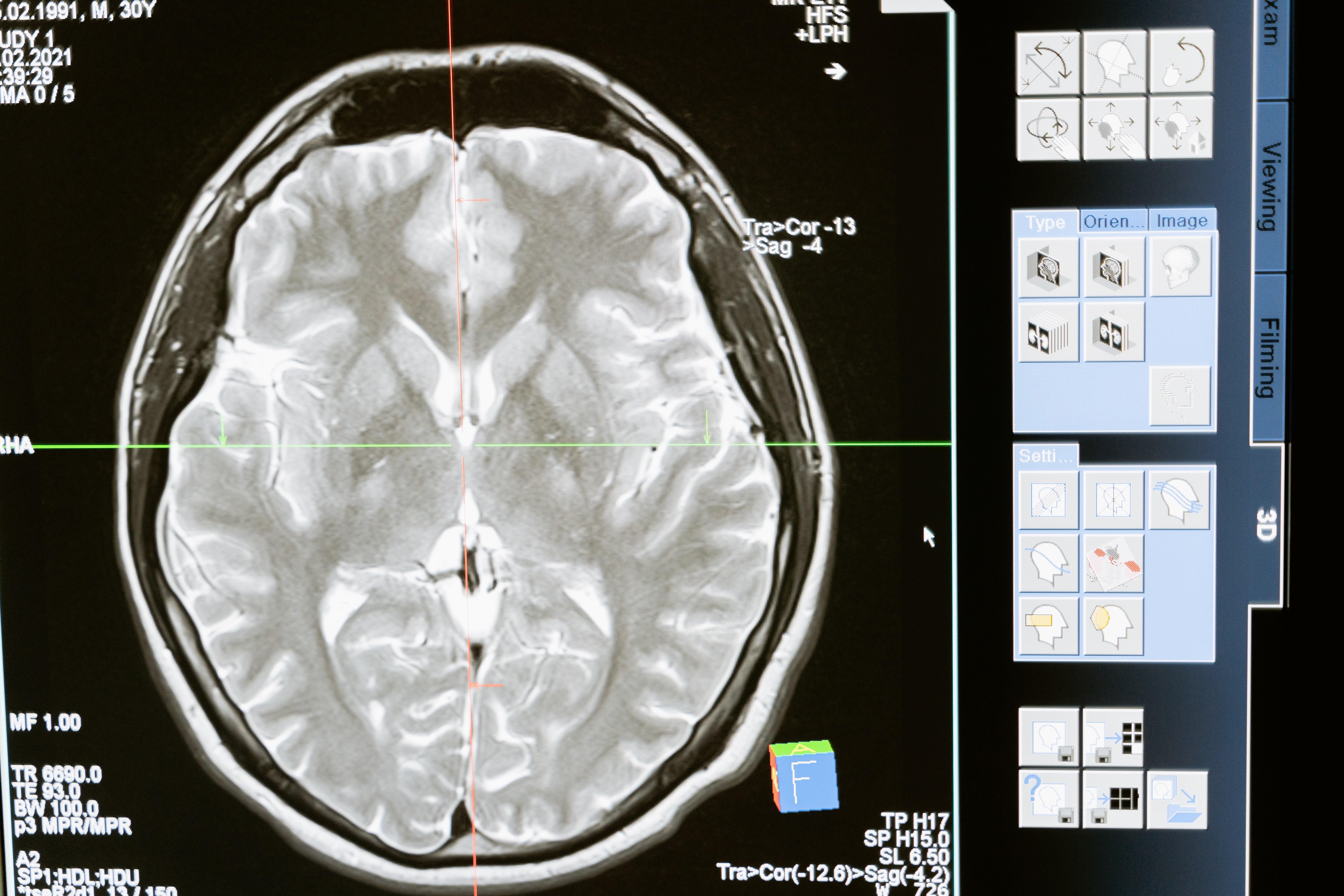 Новый алгоритм точно определяет риски деменции по томографии мозга