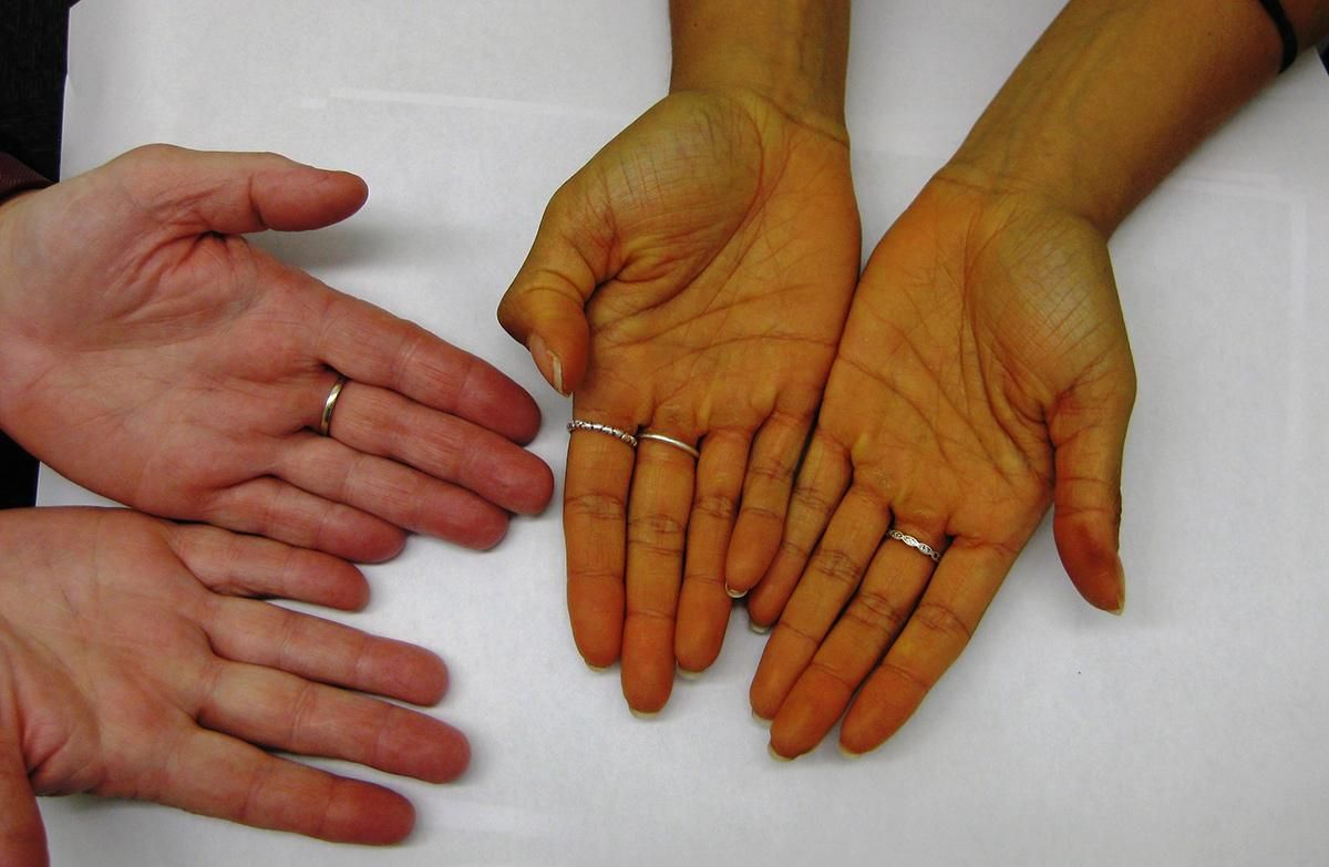 Чому жовтіє шкіра на руках та як це вилікувати - Новини Здоров’я