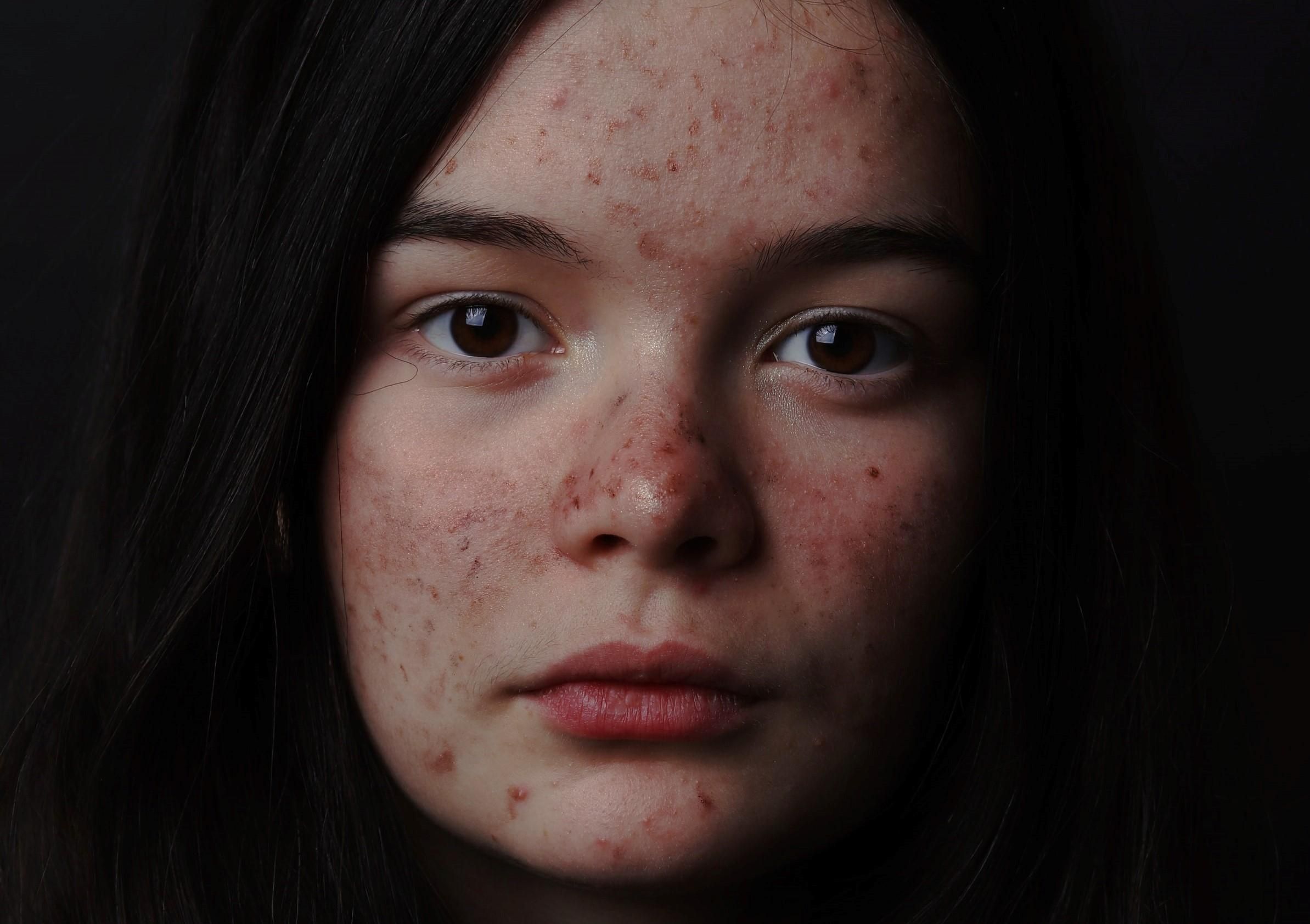 Іноді єдиним симптомом коронавірусу може бути висип на шкірі - Новини Здоров’я Іноді єдиним симптомом коронавірусу може бути висип на шкірі - Новини Здоров’я