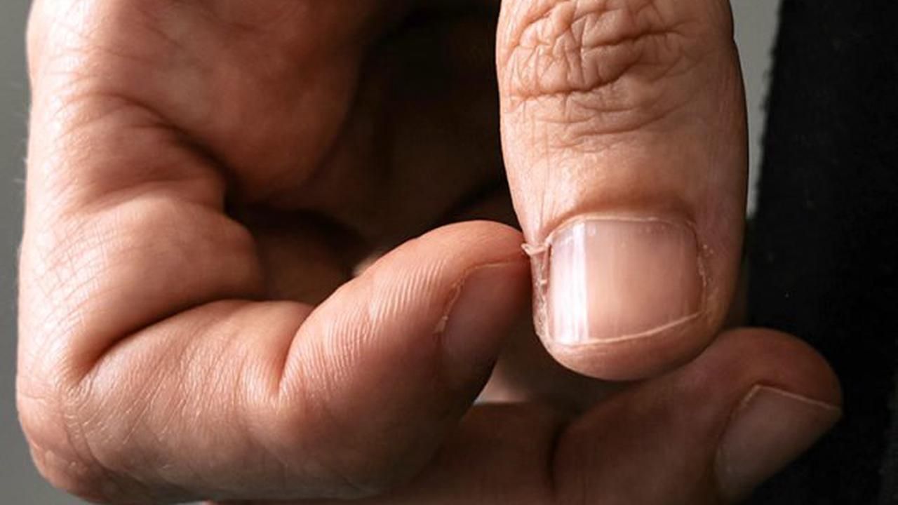 Как избавиться от заусенцев на пальцах – причины, почему они появляются 