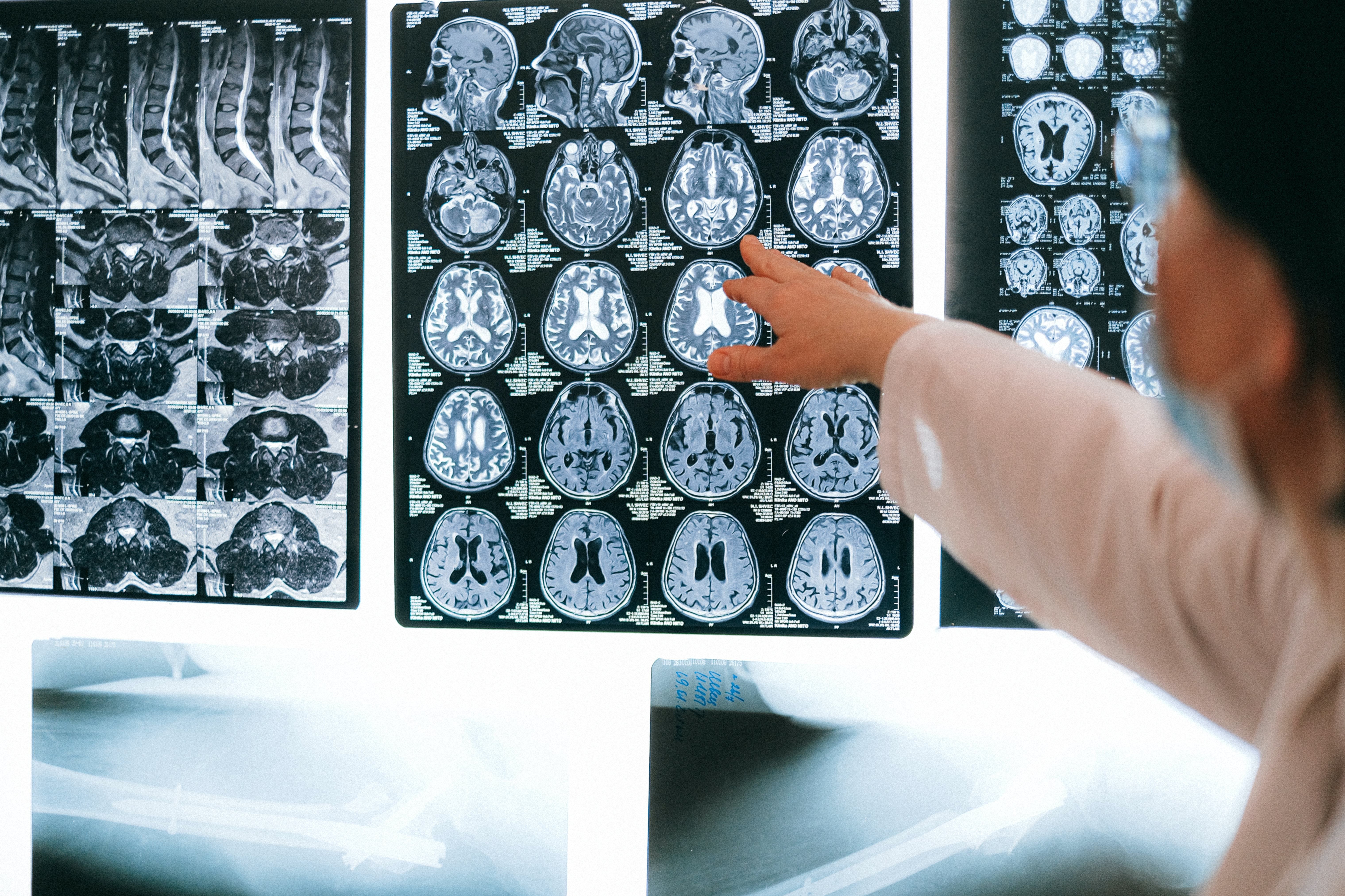 Крихітний чіп у мозку може виявляти важливі зміни після травм - Новини Здоров’я