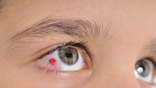 Во Львове врачи вытащили из глаза ребенка 10-сентиметрового гельминта: жуткое фото