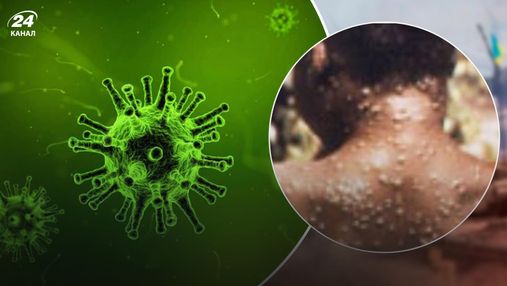 Світом шириться новий вид епідемії – віспа мавп: вірус з Африки вже дістався до Європи