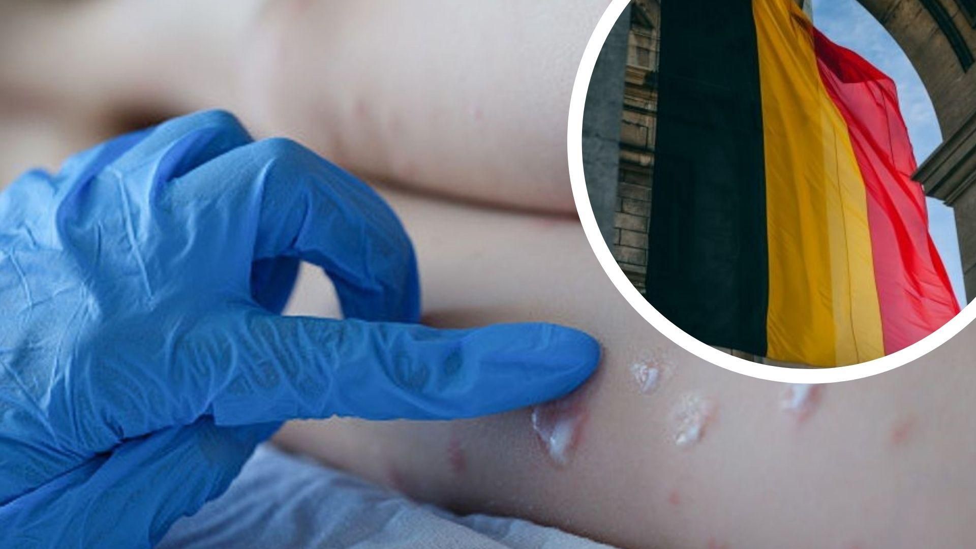 Бельгія першою введе обов'язковий 21-денний карантин для хворих на мавпячу віспу Бельгія першою введе обов'язковий 21-денний карантин для хворих на мавпячу віспу