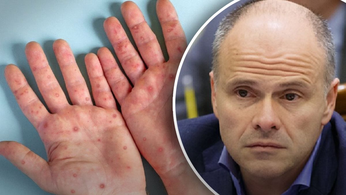 Радуцкий о первом случае обезьяньей оспы в Украине Радуцкий о первом случае обезьяньей оспы в Украине
