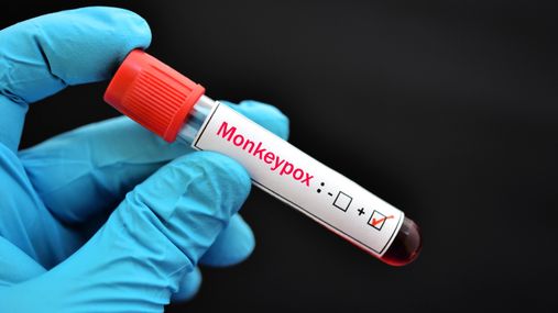 МОЗ не буде розголошувати інформацію про місце реєстрації випадків мавпячої віспи