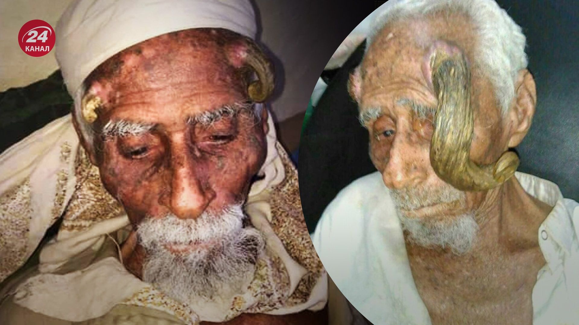 Невдовзі після невдалої операції Алі Антер помер Невдовзі після невдалої операції Алі Антер помер