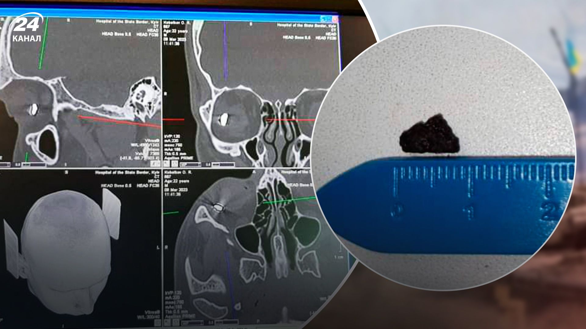 Из глаза защитника Мариуполя достали обломок длиной 1 сантиметр - Здоровье 24 Из глаза защитника Мариуполя достали обломок длиной 1 сантиметр - Здоровье 24
