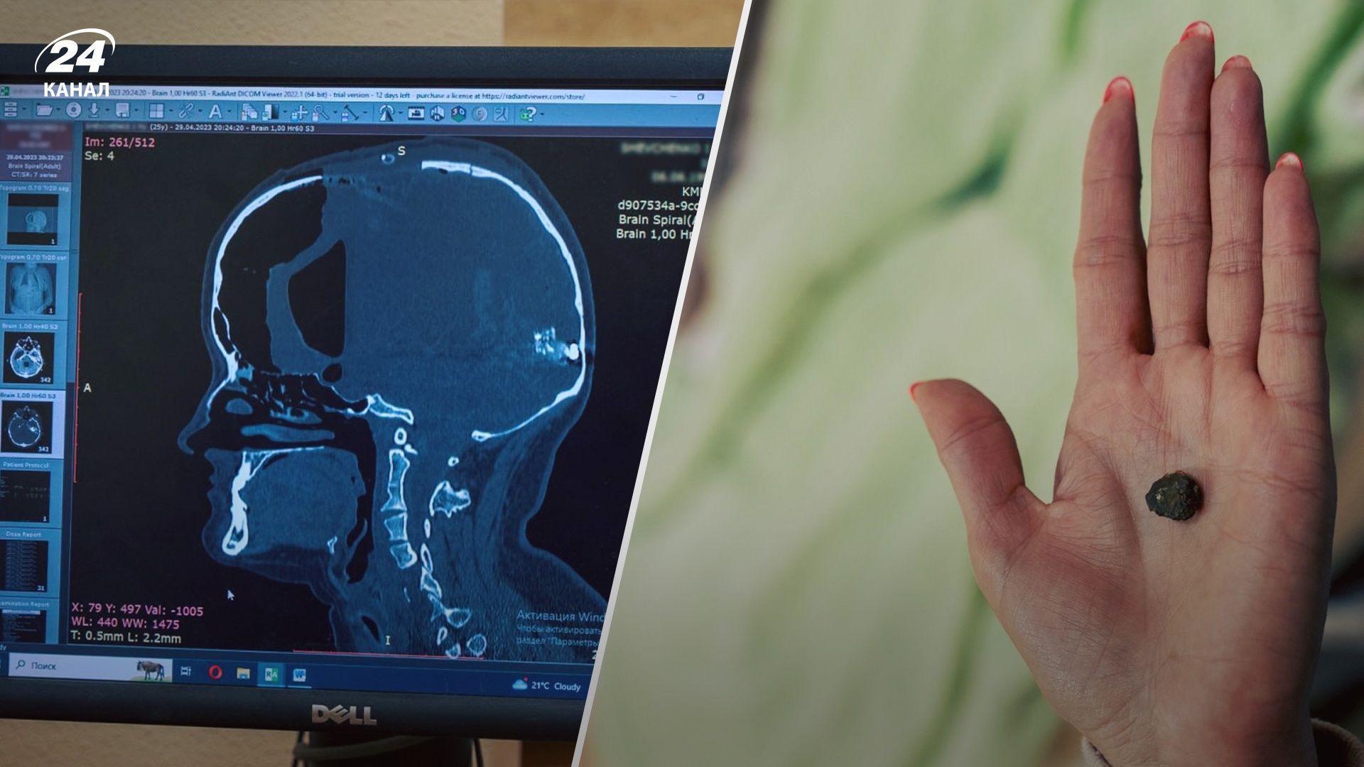 Студентка з Умані дивом вижила після ракетного удару Студентка з Умані дивом вижила після ракетного удару