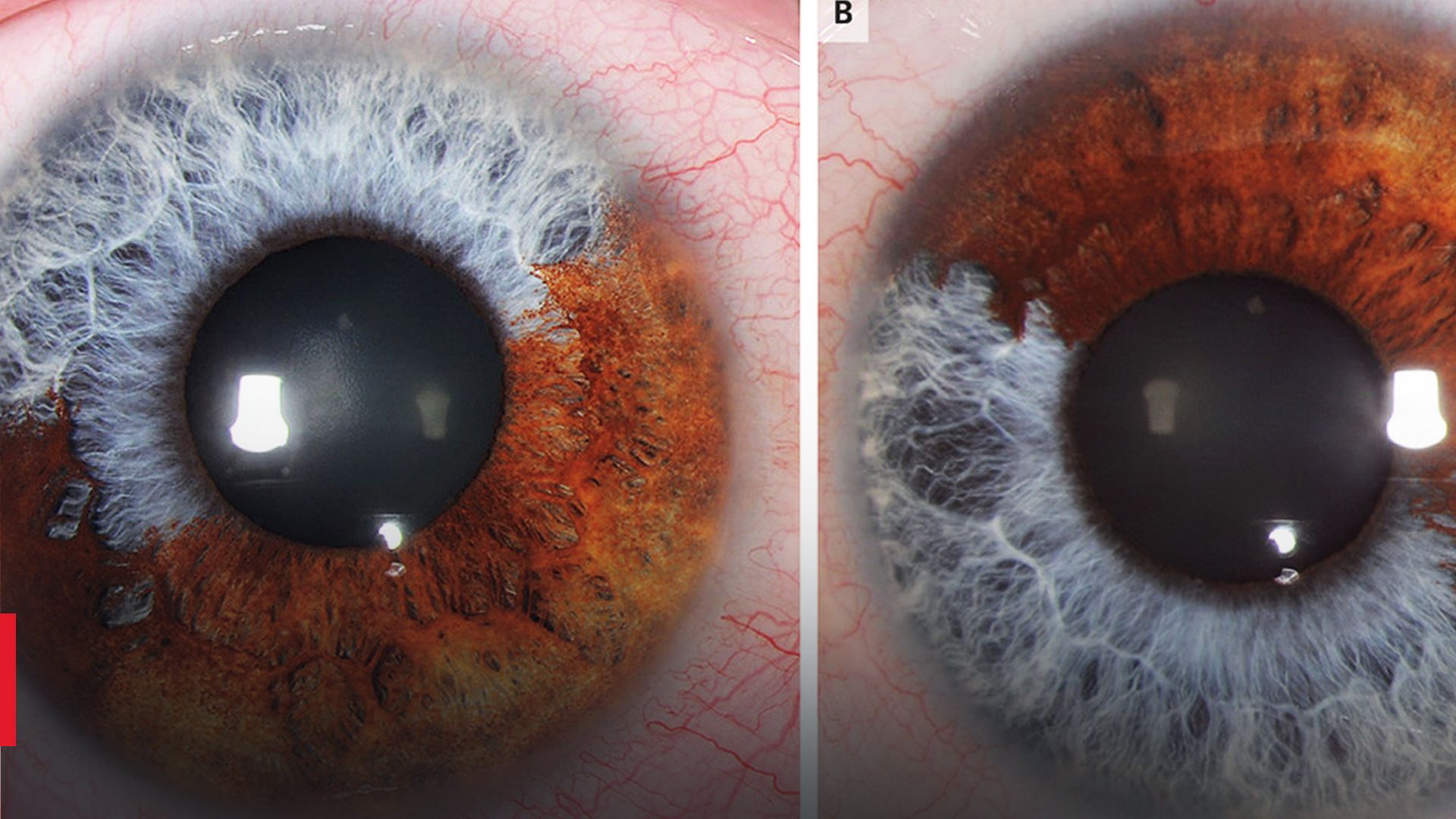 Не смогли определить цвет глаз: врачи столкнулись с редким состоянием - Здоровье 24