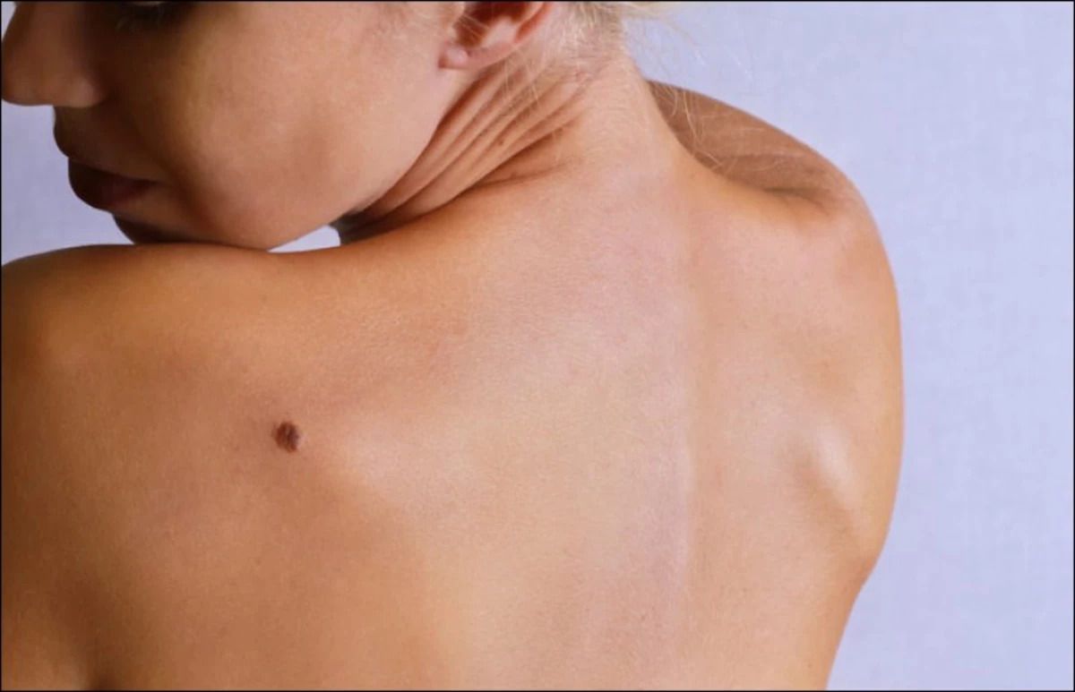 Меланома одна из самых частых причин смерти от рака кожи.