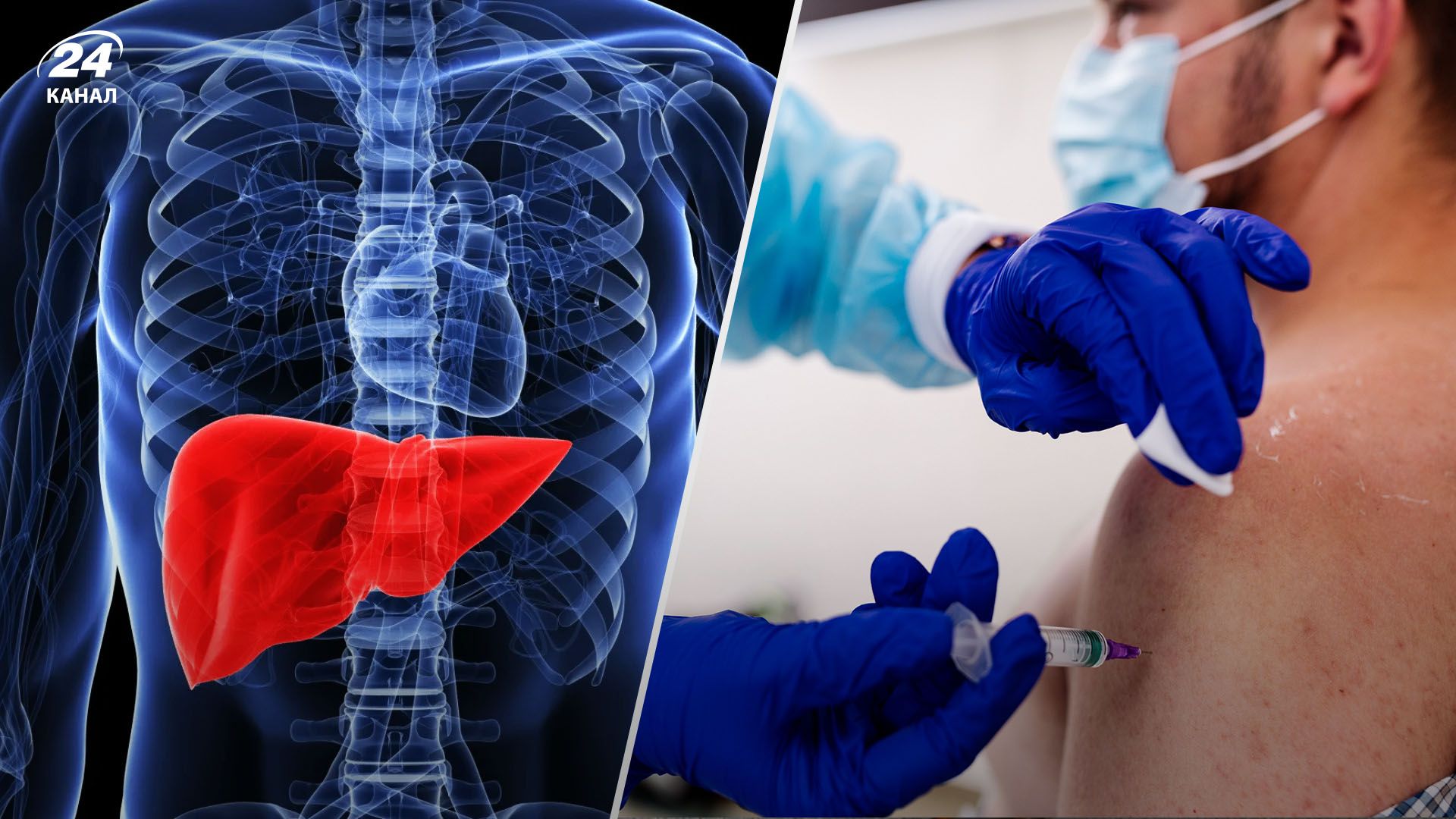 Гепатит в Украине Гепатит в Украине