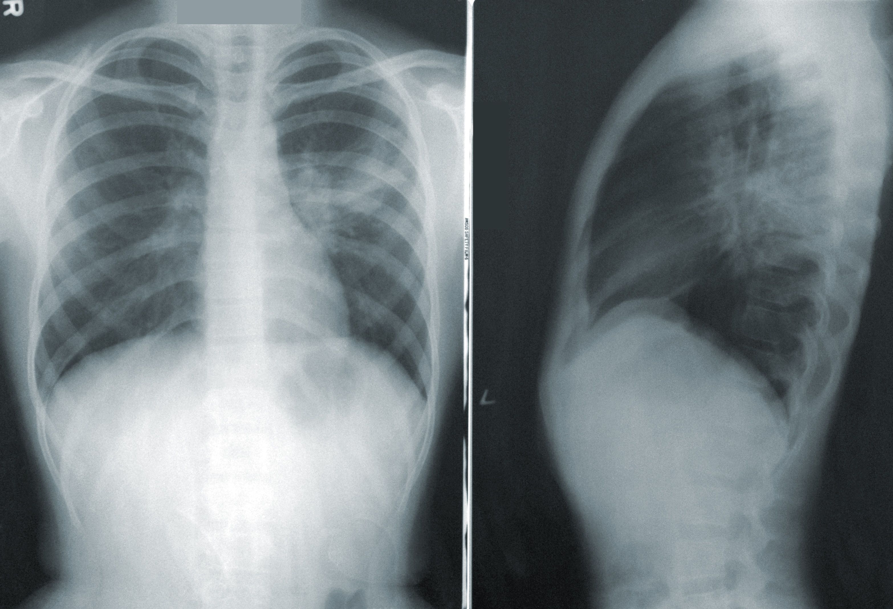 10 поражение легких. Covid 19 рентген снимок легких. Пневмония на рентгене.