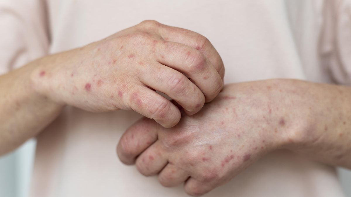 Корь в Одессе Корь в Одессе