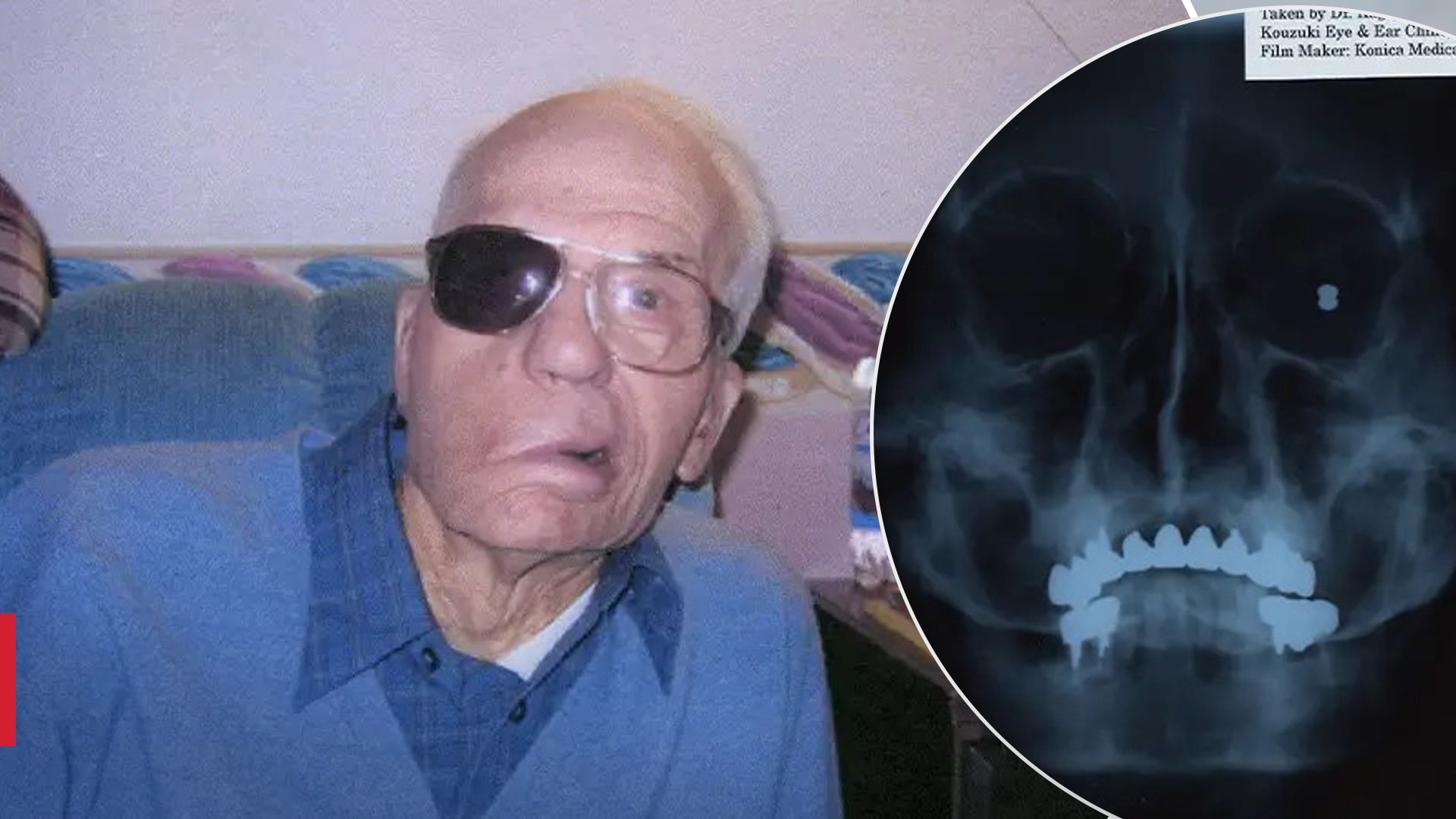 Прожил с пулей в голове 94 года: невероятный случай и история жизни Уильяма Пейса - Здоровье 24