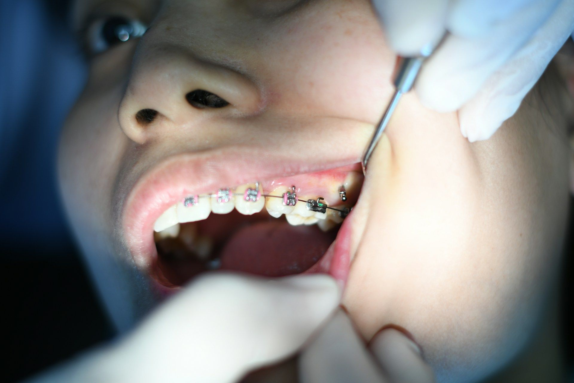 Криві зуби 