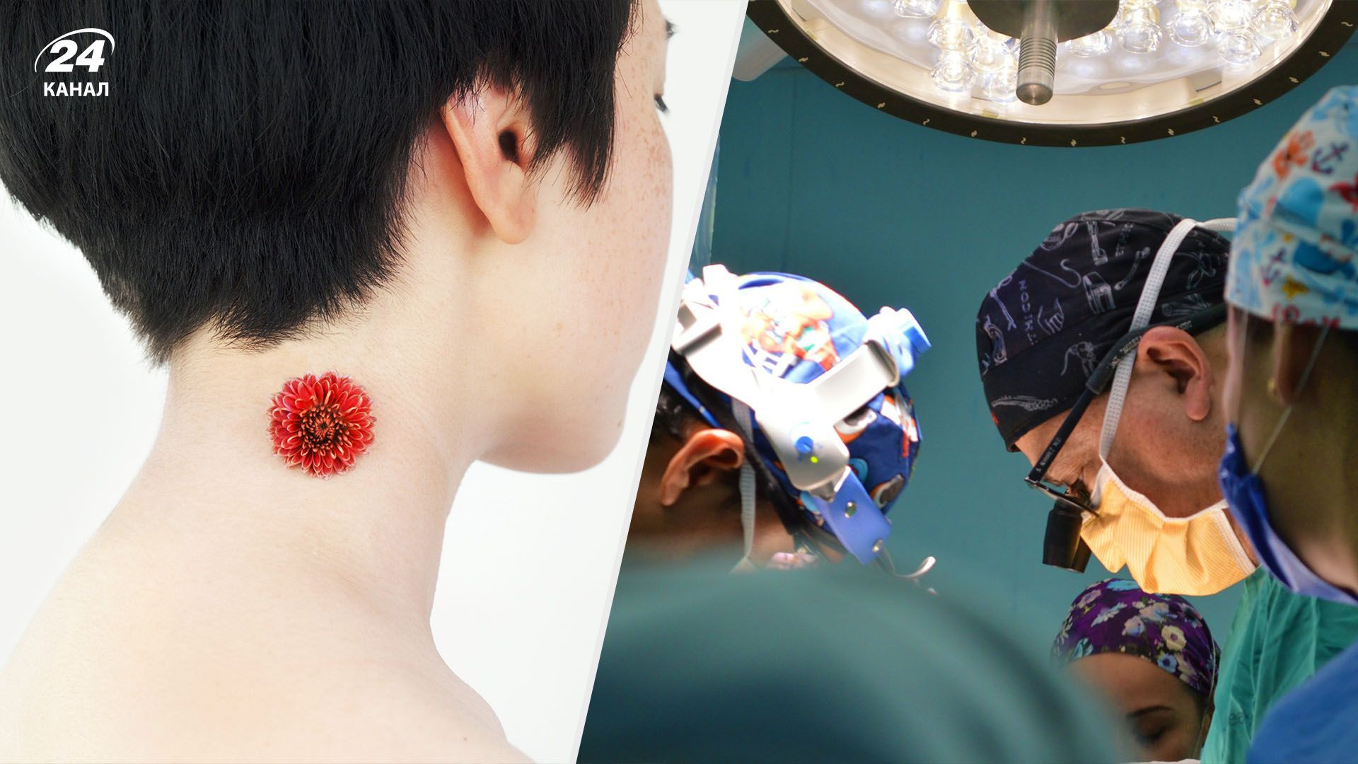 Гемангиома Гемангиома