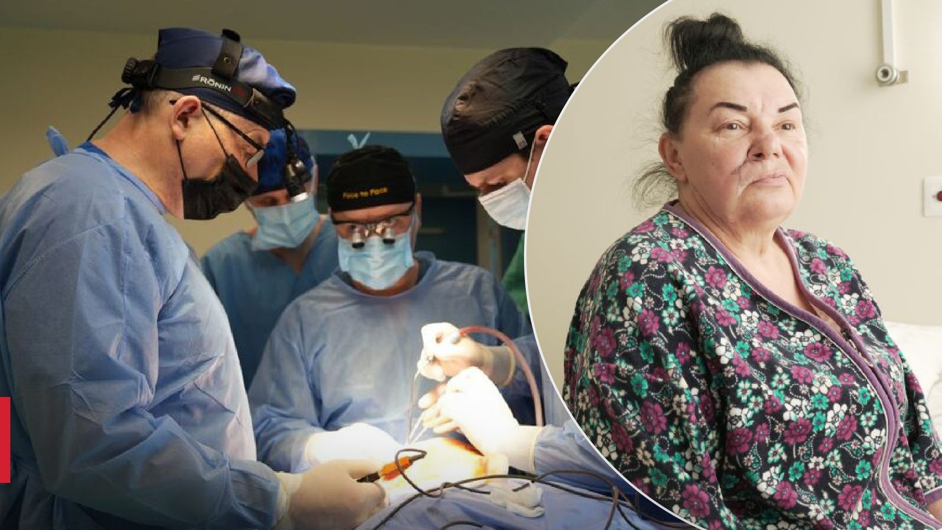 Понівечив російський снаряд: в Україні вперше провели операцію з пластики м'язів обличчя - Здоровʼя 24 Понівечив російський снаряд: в Україні вперше провели операцію з пластики м'язів обличчя - Здоровʼя 24