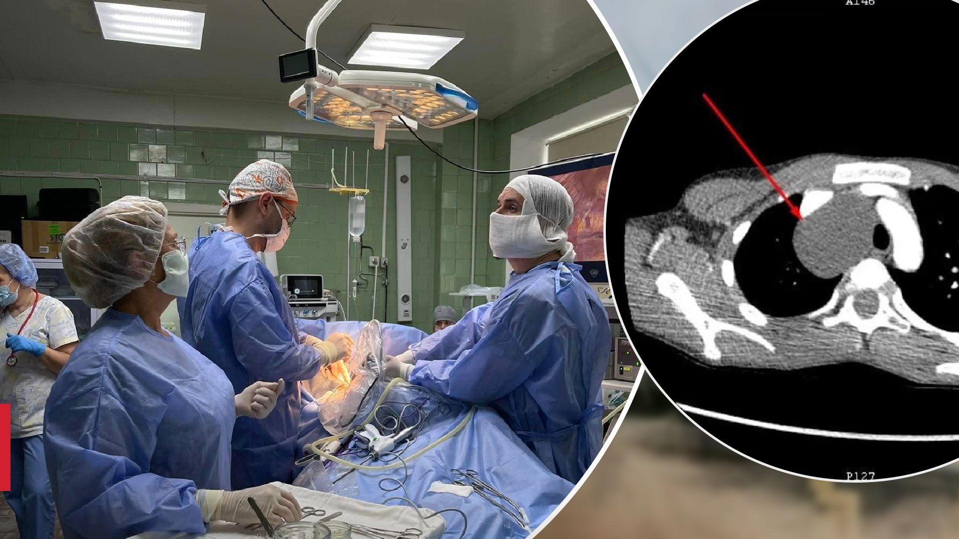 У Рівному дитині видалили 15-сантиметрову кісту У Рівному дитині видалили 15-сантиметрову кісту