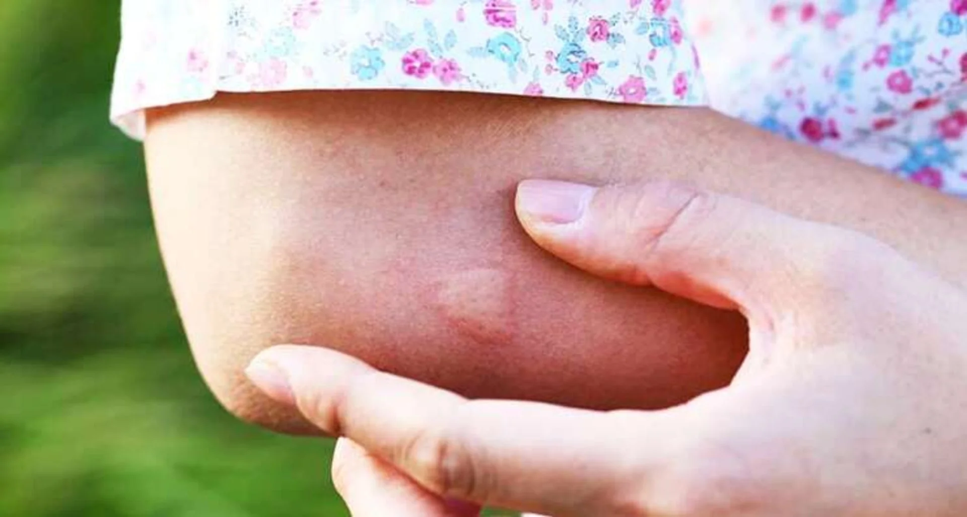 Потрапляє через укус комара: у Львові виявили дирофіляріоз, гельмінта дістали з-під шкіри - Health 24