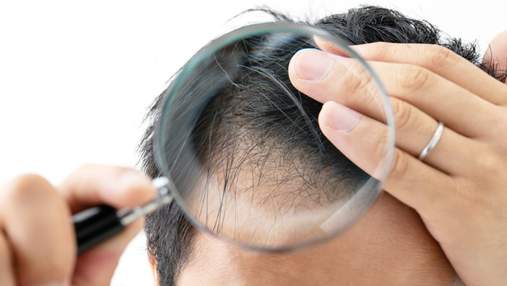 Випадіння волосся у чоловіків: ознаки, причини, лікування